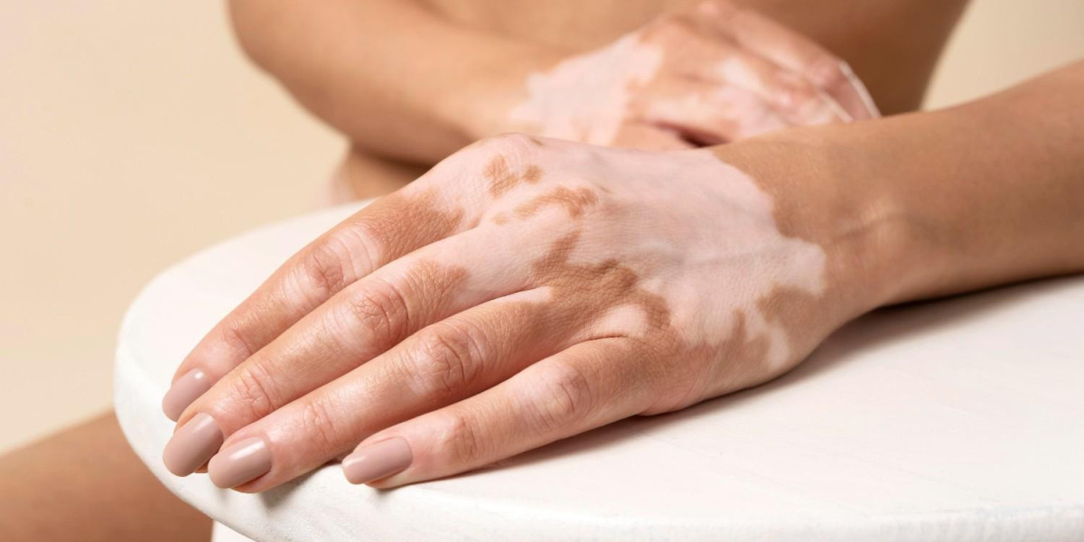 Best Vitiligo Cream & Natural Vitiligo Home Remedy | Kayakalp Global