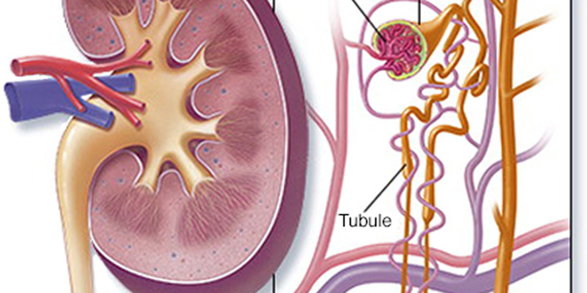 Understanding FSGS: Causes, Risks, and Its Connection to Nephrotic Syndrome!